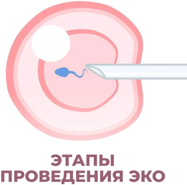 Этапы ЭКО: от стимуляции до переноса эмбриона